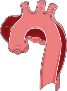 Anévrisme aorte