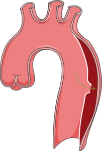 Anévrisme aorte