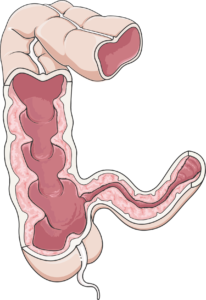 colon (maladie de Crohn)