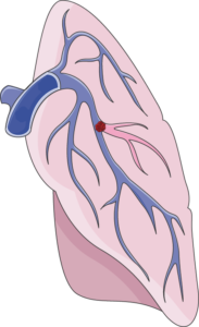 Embolie pulmonaire