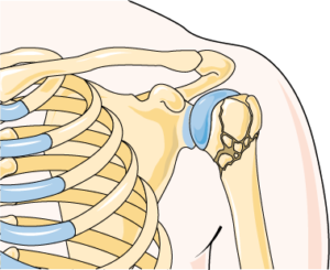 Fracture épaule