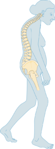 Ostéoporose sévère