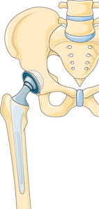 Prothèse totale hanche