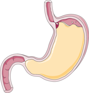 Reflux gastrointestinal