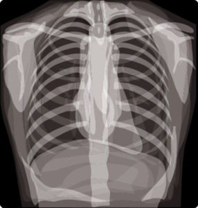 Radiographie thorax