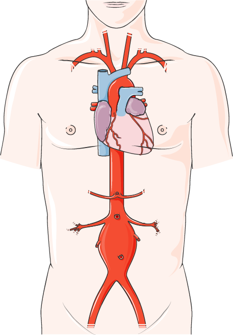 Aorta abdominalis aneurisma Aneurysma in
