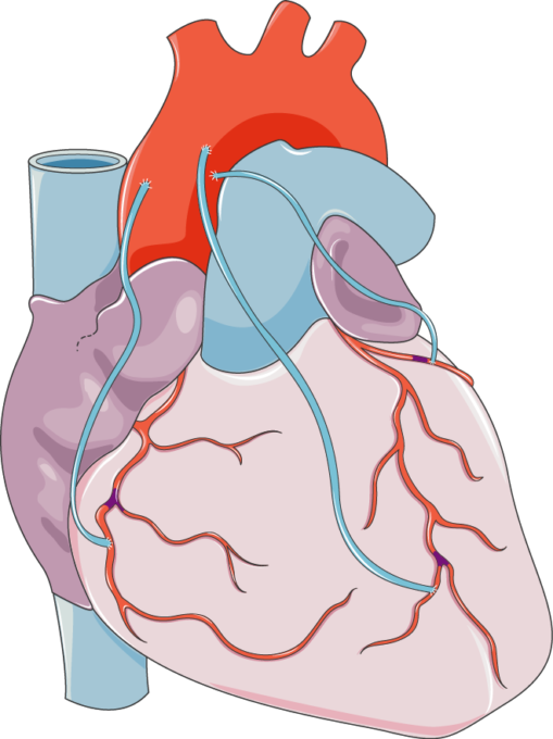 coronary-artery-bypass-grafting-servier-medical-art