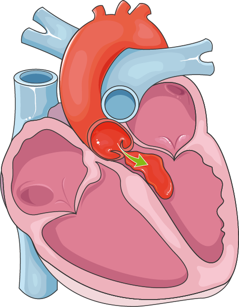 aortic-valve-regurgitation-servier-medical-art